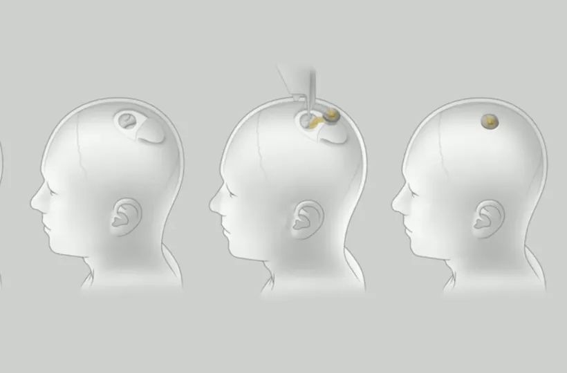 Neuralink Implant Concept